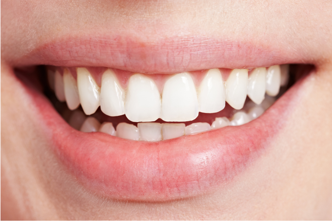A close up of a woman's teeth showing a clean white smile