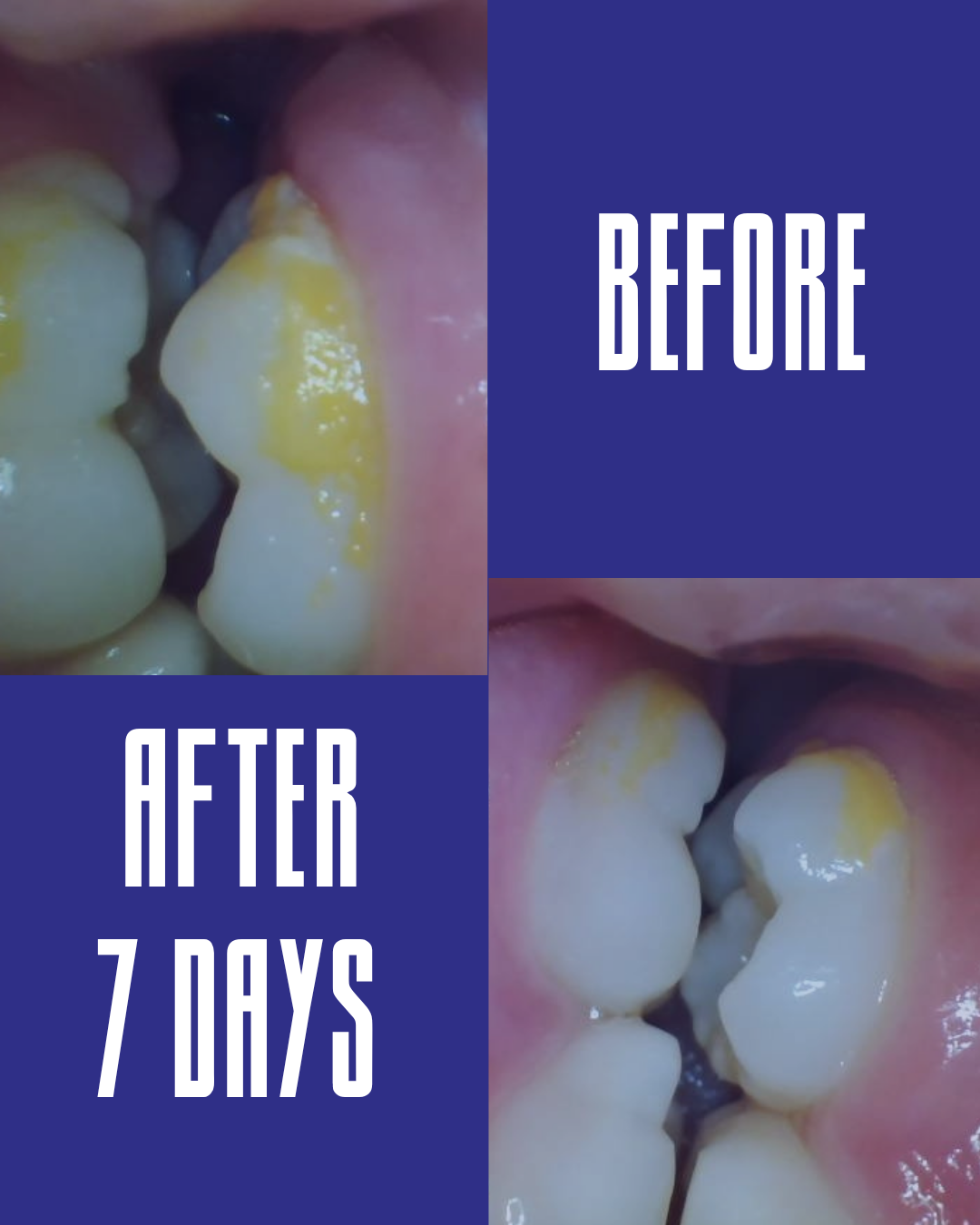 [Prototype] The Honest Tooth — Antiplaque Toothpaste